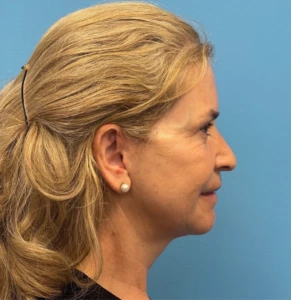 Facelift-Case--292 | After Face 2