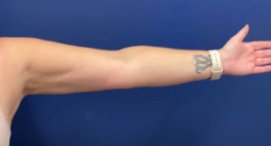 Case--399 | After Body 2