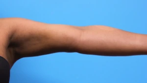 Case--279 | After Body 2