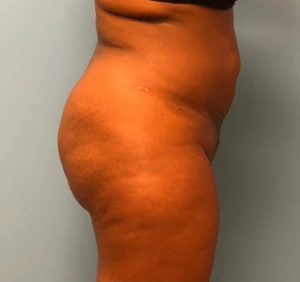 Brazilian-Butt-Lift-Case--13244 | After Body 2