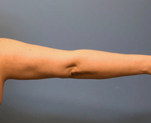 Brachioplasty-Case--78 | After Arm Lift 2