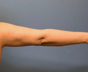 Brachioplasty-Case--78 | After Dr. Samir Rao 2