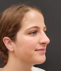 Rhinoplasty-and-Chin-Implant-Case--381 | After Dr. Arjun Kanuri 2