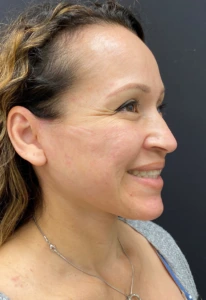 Facelift-Case--364 | After Face 2