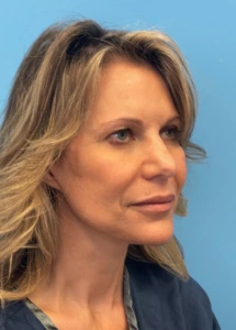 Facelift-Case--18078 | After Face 2