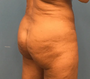 Brazilian-Butt-Lift-Case--74 | After Body 2