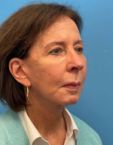 Facelift-Case--25941 | After Dr. Samir Rao 2