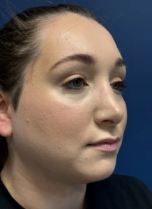 Submental-Liposuction-Case--29107 | After Face 2