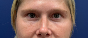 Blepharoplasty-Case--29601 | After Eyelid Surgery 2