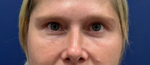 Blepharoplasty-Case--29601 | After Face 2