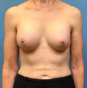 Revision-Augmentation-Case--236 | Before Revision Augmentation 1