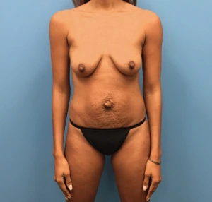 Mommy-Makeover-Case--262 | Before Body 1