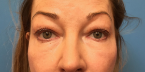 Upper-Blepharoplasty-Case--393 | Before Eyelid Surgery 1
