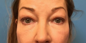 Upper-Blepharoplasty-Case--393 | Before Face 1