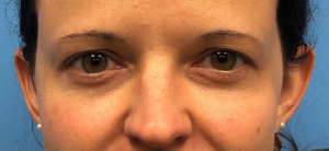 Upper-Blepharoplasty-Case--14261 | Before Eyelid Surgery 1