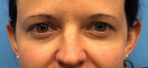 Upper-Blepharoplasty-Case--14261 | Before Face 1