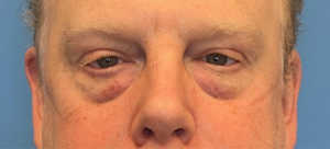 Lower-Blepharoplasty-Case--289 | Before Eyelid Surgery 1