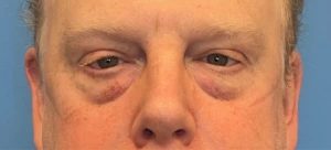 Lower-Blepharoplasty-Case--289 | Before Face 1