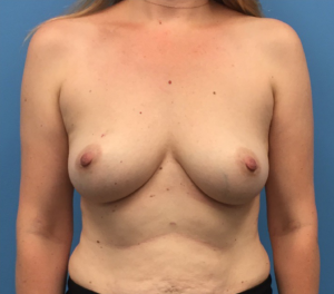 Breast-Reconstruction-Case--295 | Before Dr. Samir Rao 1