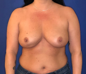 Breast-Reconstruction-Case--306 | Before Dr. Samir Rao 1