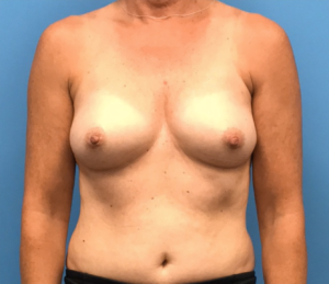 Breast-Reconstruction-Case--310 | Before Dr. Samir Rao 1