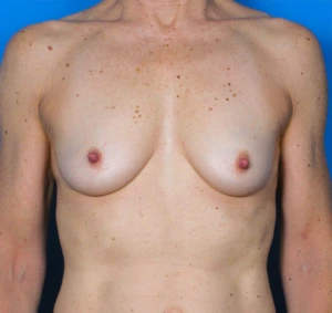 Breast-Reconstruction-Case--312 | Before Breast Reconstruction 1