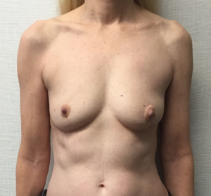 Breast-Reconstruction-Case--313 | Before Dr. Samir Rao 1