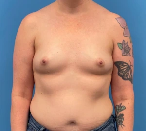 Breast-Reconstruction-Case--335 | Before Breast Reconstruction 1