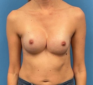 Case--317 | Before Breast Reconstruction 1