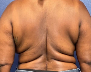 Body-Lift-Case--275 | Before Body 1