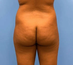 Brazilian-Butt-Lift-Case--263 | Before Body 1