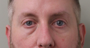 Lower-Blepharoplasty-Case--359 | Before Eyelid Surgery 2