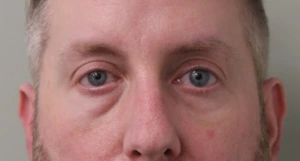 Lower-Blepharoplasty-Case--359 | Before Face 2