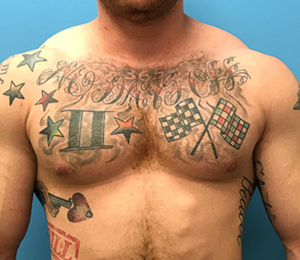 Gynecomastia-Case--143 | Before Gynecomastia / Male Breast Reduction 1