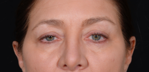 Quad-Blepharoplasty-Case--358 | Before Eyelid Surgery 2