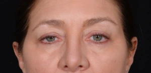Quad-Blepharoplasty-Case--358 | Before Face 2