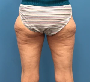 Case--10165 | Before Body 1