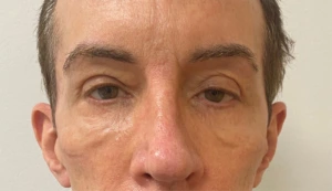 Quad-Blepharoplasty-Case--357 | Before Face 2