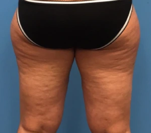 Case--278 | Before Body 2