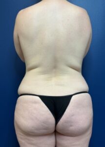 Tummy-Tuck-Case--9602 | Before Tummy Tuck 2