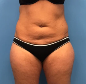Liposuction-Case--72-1 | Before Body 1