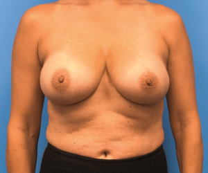 Breast-Reconstruction-Case--294 | Before Dr. Samir Rao 1