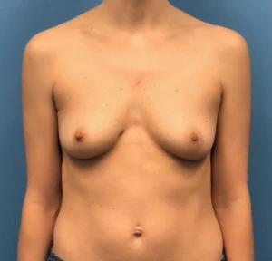 Breast-Reconstruction-Case--300 | Before Dr. Samir Rao 1