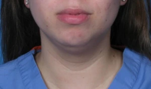 Case--293 | Before Face 1