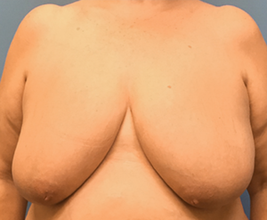 Breast-Reduction-Case--130 | Before Breast Reduction 1