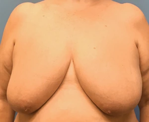 Breast-Reduction-Case--130 | Before Breast Reduction 1