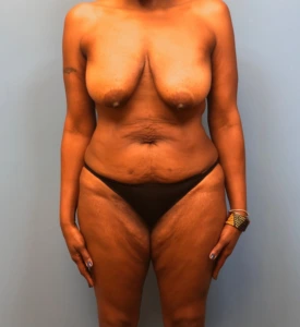 Mommy-Makeover-Case--13869 | Before Body 1