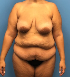 Lipoabdominoplasty-Breast-Augmentation-Case--15133 | Before Body 1