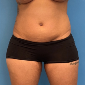 Case--25704 | Before Liposuction 1