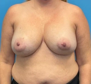 Breast-Reconstruction-Case--25682 | Before Dr. Frank Albino 1